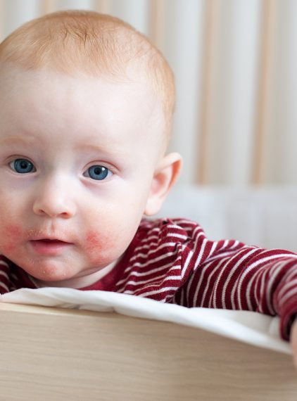 Dieta w atopowym zapaleniu skóry (AZS). Na co zwrócić uwagę?