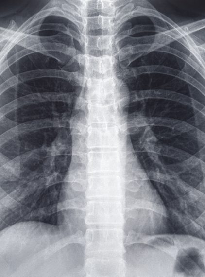 Na czym polega badanie RTG?