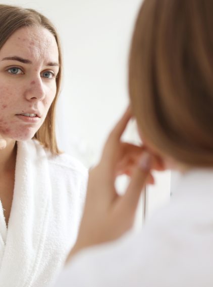 Trądzik pospolity – jak go leczyć?