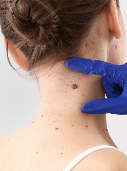 Kiedy powinno się usunąć pieprzyk?