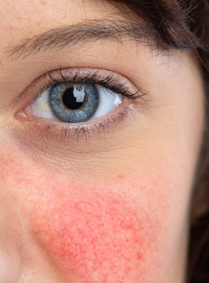 Laserowe zamykanie naczynek – czego unikać przed zabiegiem?