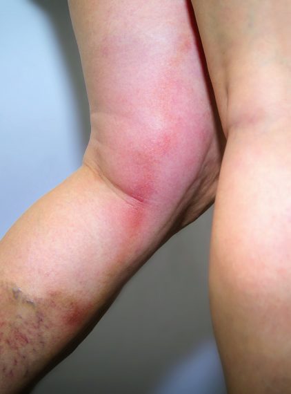 Zakrzepowe zapalenie żył powierzchownych – jak je leczyć?