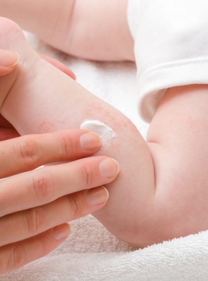 Kontaktowe zapalenie skóry u dzieci – jak je leczyć?