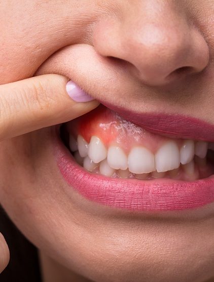 Owrzodzenie Jamy Ustnej Przyczyny Objawy Leczenie 45 Off 2611