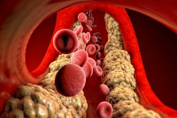 Hipercholesterolemia rodzinna – co to jest? Przyczyny, objawy i leczenie