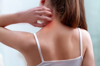 Alergia skórna. Przyczyny, objawy i leczenie. Jak złagodzić uczulenie na skórze?