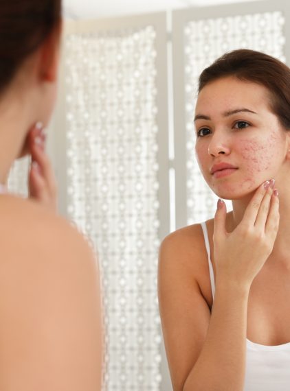 Izotretynoina. Ratuje i rujnuje skórę?