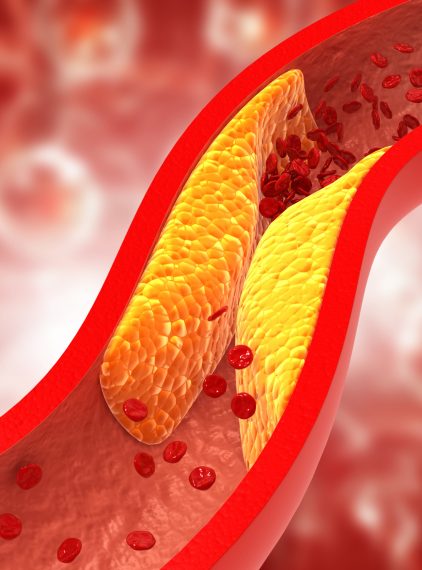 Choroby Serca Rodzaje Objawy Badania Leczenie Profilaktyka Strona 3 Z 3 Poradnik 0448