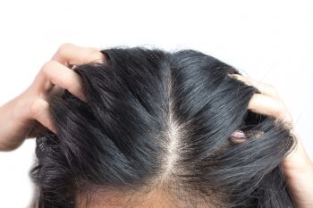 Łupież łojotokowy. Jak go leczyć?