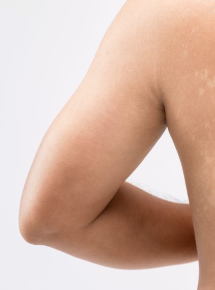 Łupież pstry – przyczyny, objawy i leczenie