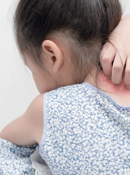 Łuszczyca u dzieci. Jak wyglądają objawy?