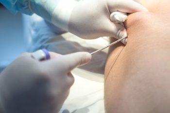 Biopsja szpiku kostnego – wskazania i przebieg