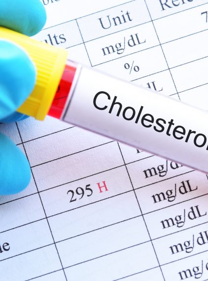 Wysoki cholesterol. Jakie są przyczyny i objawy? Jak go obniżyć?
