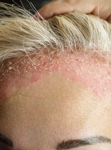 Łupież czerwony mieszkowy – jakie są jego przyczyny, objawy, diagnostyka i sposoby leczenia?