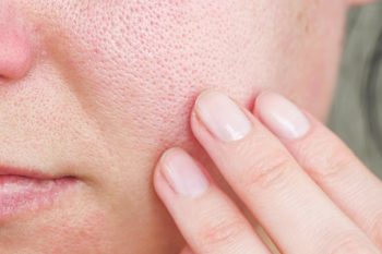 Jak zamknąć pory? Skuteczne zabiegi na rozszerzone pory