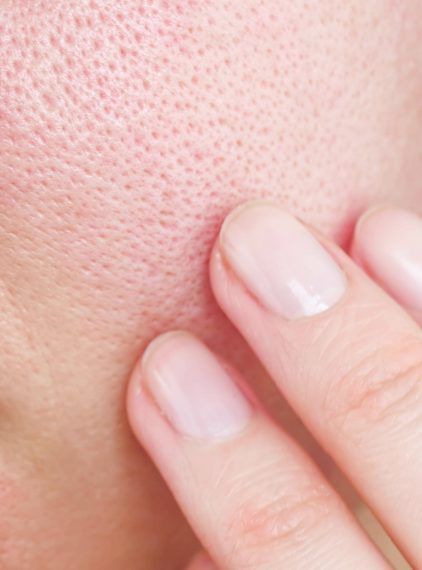 Jak zamknąć pory? Skuteczne zabiegi na rozszerzone pory