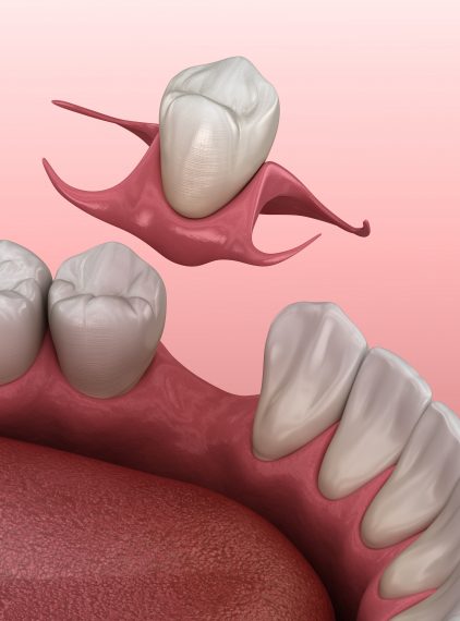 Protezy natychmiastowe – co warto o nich wiedzieć?