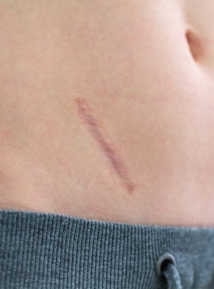 Dieta po operacji resekcji wyrostka robaczkowego