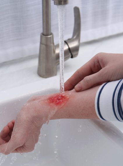 Pierwsza pomoc w oparzeniach