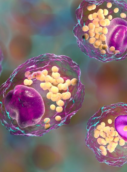 Lipemia – co to jest? Przyczyny, objawy i leczenie
