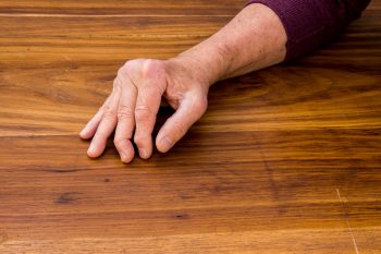 Łuszczycowe zapalenie stawów. Jak objawia się ŁZS?