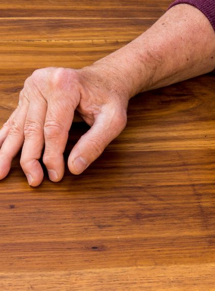 Łuszczycowe zapalenie stawów. Jak objawia się ŁZS?