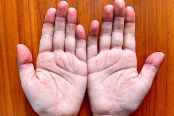 Sinica – przyczyny, objawy i rodzaje