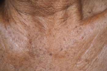 Rogowacenie słoneczne – przyczyny, objawy i leczenie