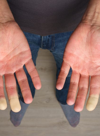 Objaw Raynauda – czym jest?