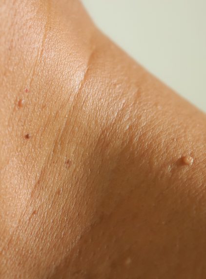 Jak usunąć włókniaki?