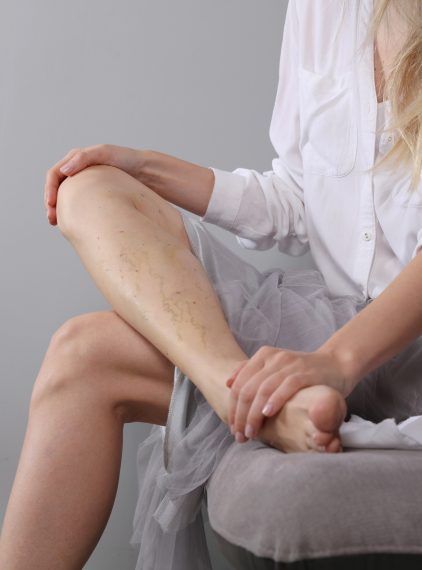 Pajączki na nogach – przyczyny, objawy i leczenie. Jak pozbyć się popękanych naczynek na nogach?