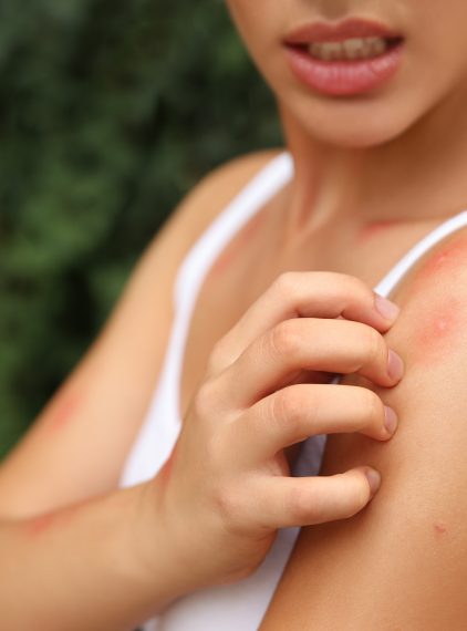 Uczulenie na komary. Jak się objawia?