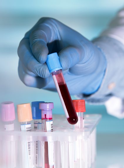 Podwyższony potas we krwi – co może być przyczyną?