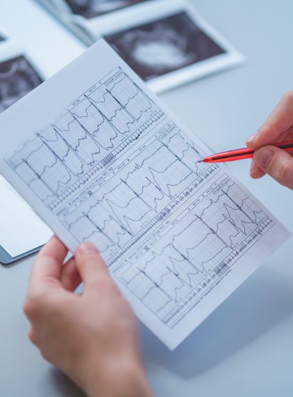Migotanie przedsionków – objawy, rozpoznanie i leczenie