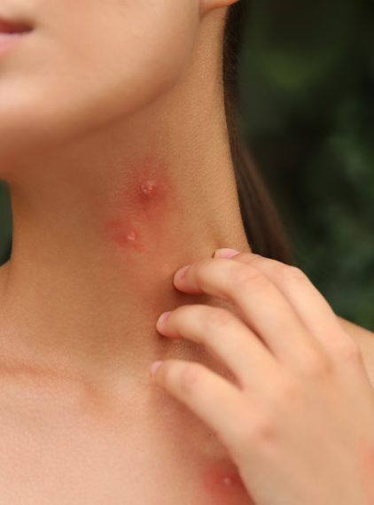 Dlaczego niektórych ludzi komary gryzą częściej?