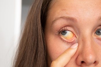 Zespół Gilberta – co to za choroba?