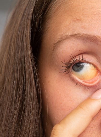 Zespół Gilberta – co to za choroba?