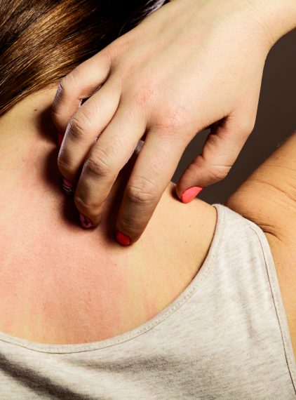 Pokrzywka cholinergiczna – nadmierna wrażliwość na pot