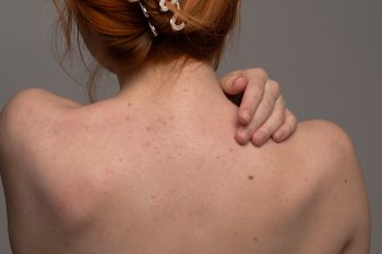 Trądzik na plecach. Przyczyny i jak się pozbyć pryszczy na plecach
