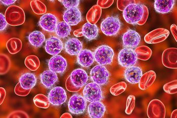 Ostra białaczka limfoblastyczna – przyczyny, objawy, leczenie