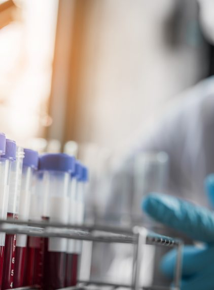 Pierwotne stwardniające zapalenie dróg żółciowych – przyczyny, objawy, leczenie