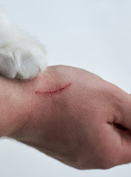 Choroba kociego pazura. Czym grozi zadrapanie przez kota?