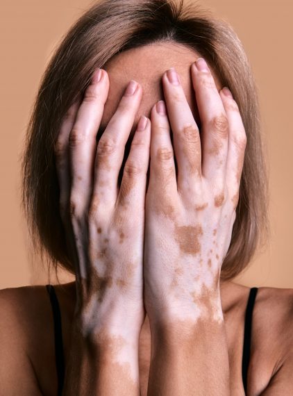 Bielactwo. Czy można je leczyć?