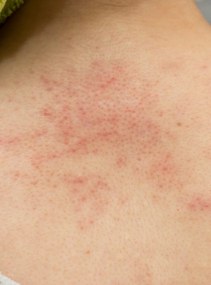 Co stosować na zapalenie mieszków włosowych?