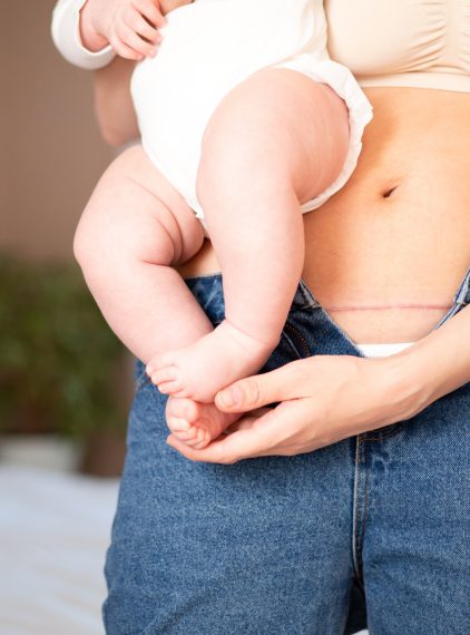 Cesarskie cięcie – wskazania, przygotowanie, przebieg