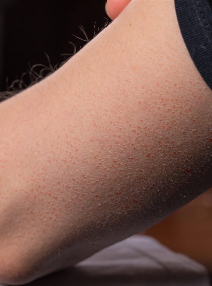 Rogowacenie okołomieszkowe – przyczyny, objawy, leczenie