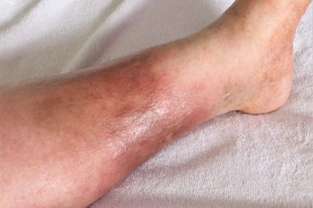 Cellulitis (zapalenie tkanki łącznej) – czym się różni od cellulitu?