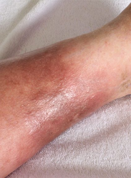 Cellulitis (zapalenie tkanki łącznej) – czym się różni od cellulitu?