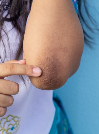 Rogowacenie ciemne – przyczyny, objawy, leczenie