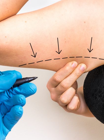 Liposukcja – co to jest i jak wygląda zabieg?